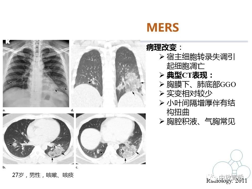 【PPT】COVID-19影像表现及研究进展