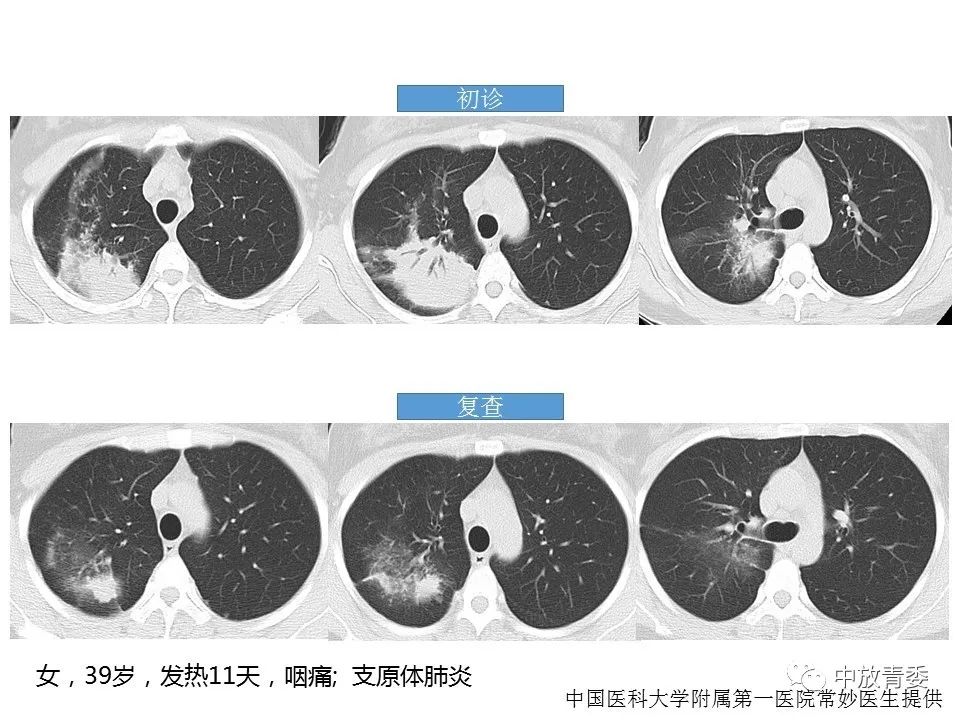 【PPT】COVID-19影像表现及研究进展