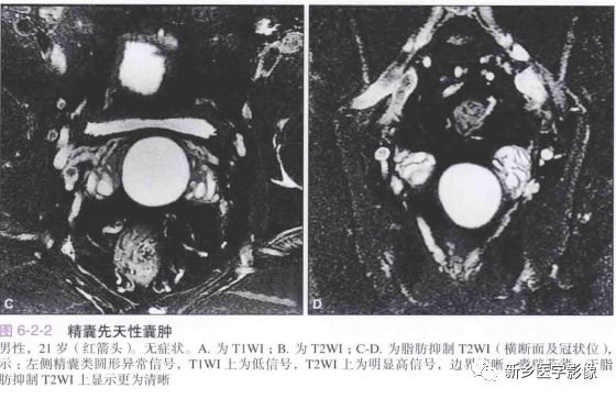精囊先天异常 精囊先天异常