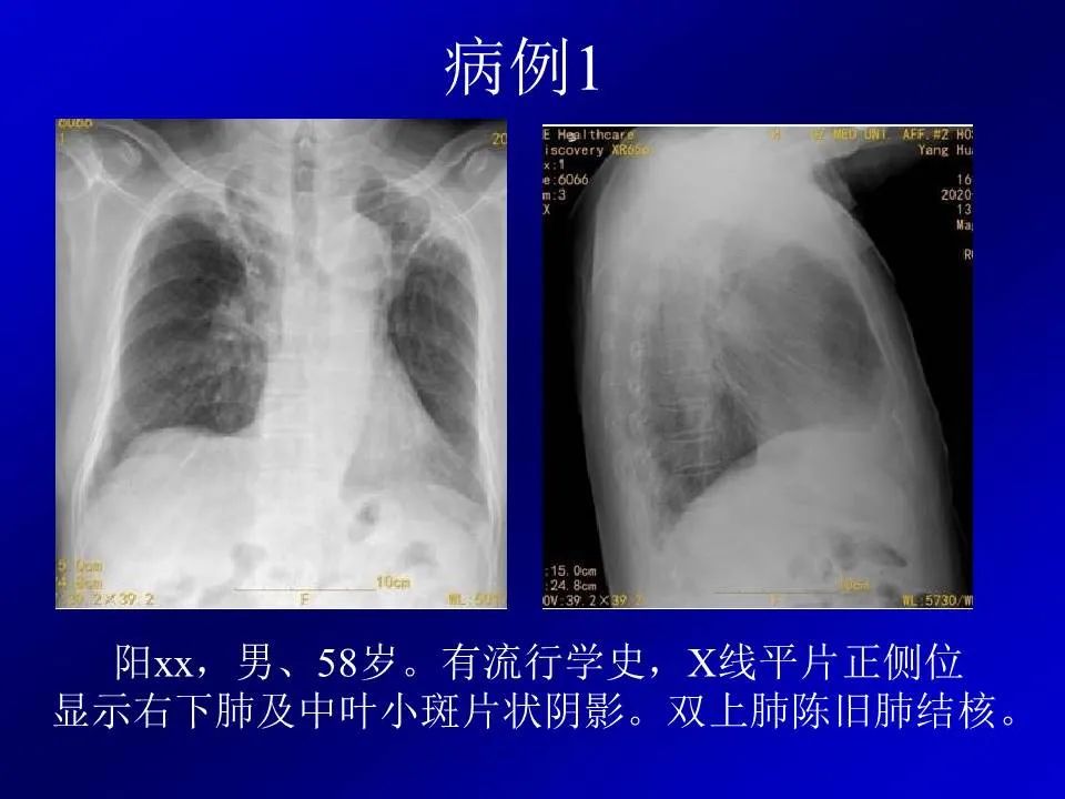 【PPT】新型冠状病毒肺炎影像学诊断及鉴别诊断