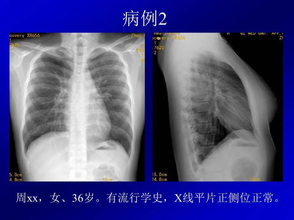 【PPT】新型冠状病毒肺炎影像学诊断及鉴别诊断