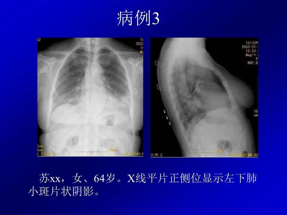 【PPT】新型冠状病毒肺炎影像学诊断及鉴别诊断
