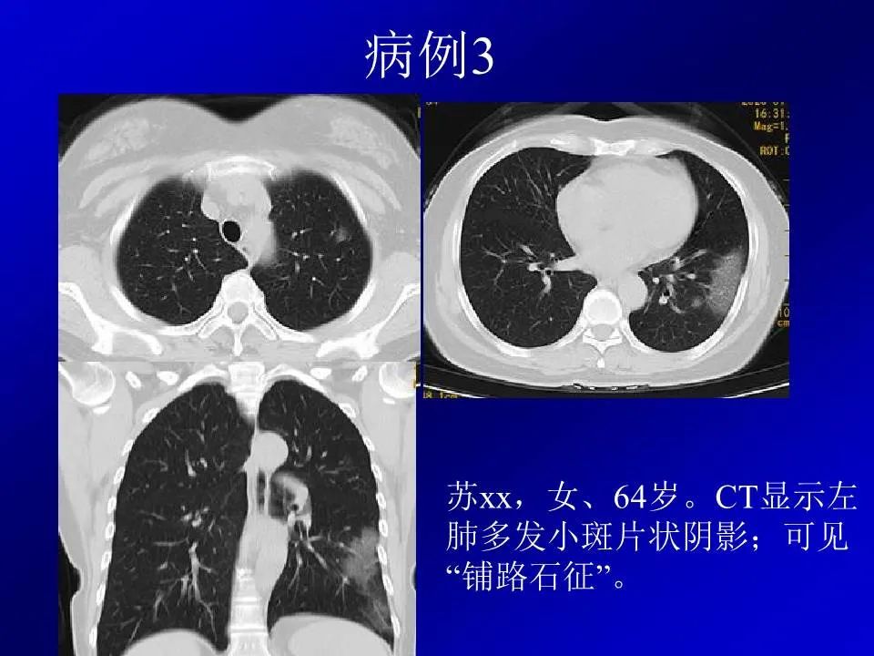 【PPT】新型冠状病毒肺炎影像学诊断及鉴别诊断