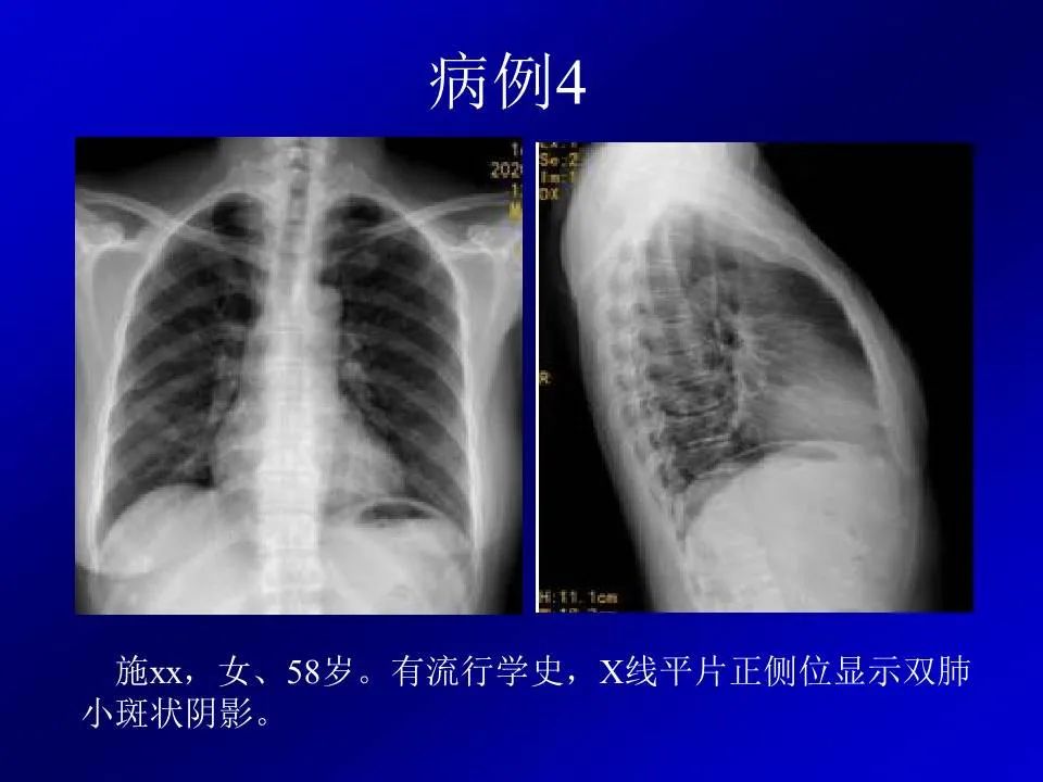 【PPT】新型冠状病毒肺炎影像学诊断及鉴别诊断