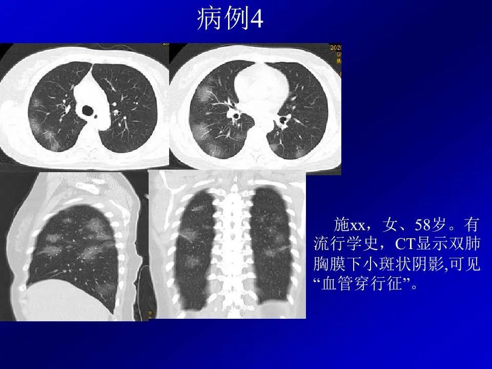 【PPT】新型冠状病毒肺炎影像学诊断及鉴别诊断