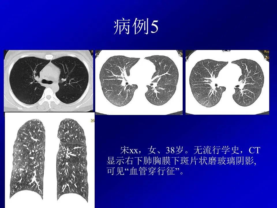 【PPT】新型冠状病毒肺炎影像学诊断及鉴别诊断
