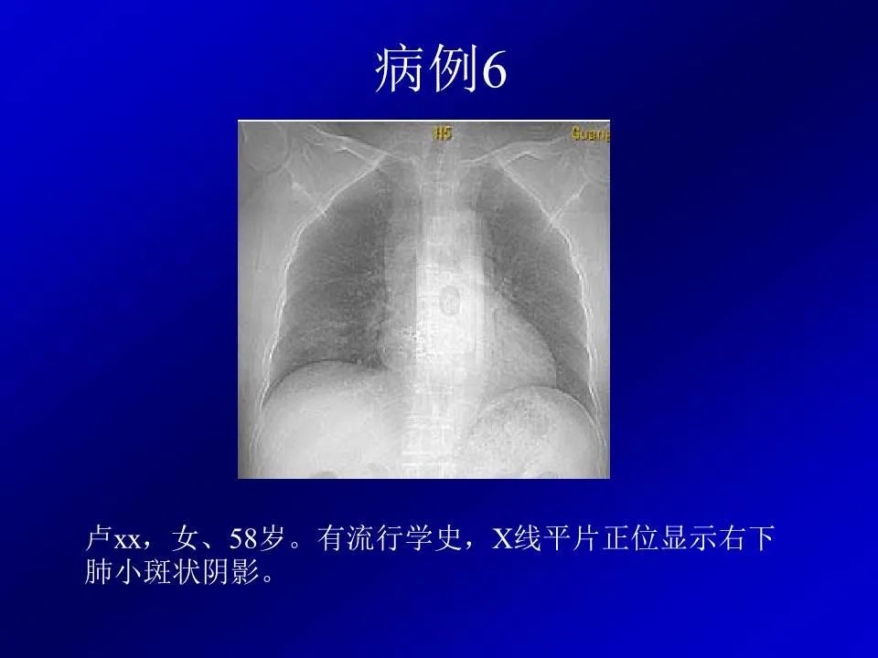 【PPT】新型冠状病毒肺炎影像学诊断及鉴别诊断