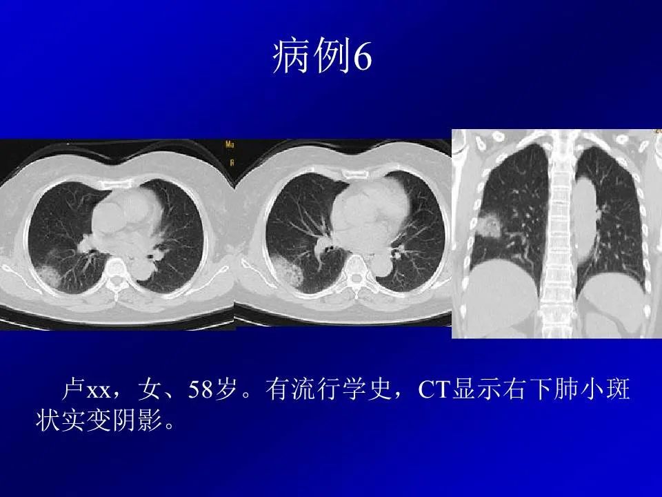 【PPT】新型冠状病毒肺炎影像学诊断及鉴别诊断