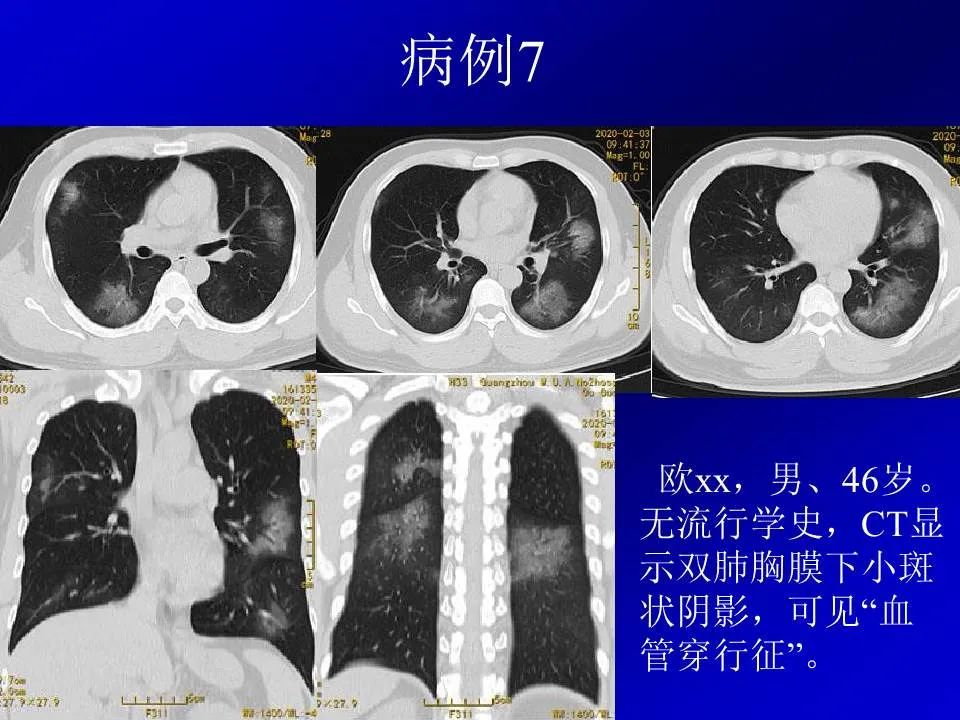 【PPT】新型冠状病毒肺炎影像学诊断及鉴别诊断