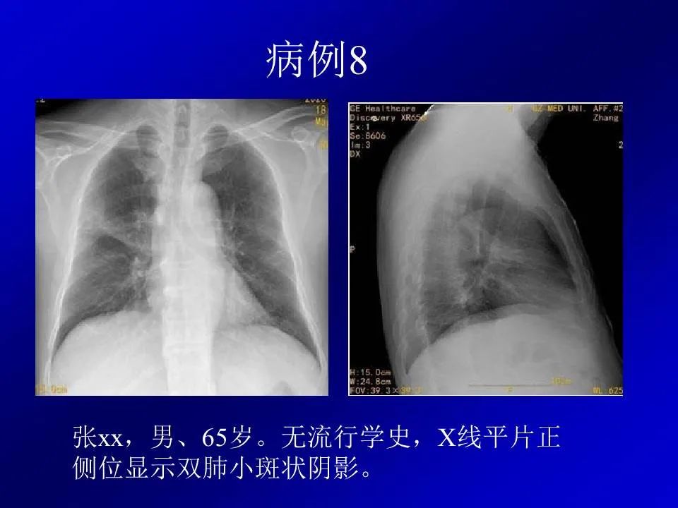 【PPT】新型冠状病毒肺炎影像学诊断及鉴别诊断