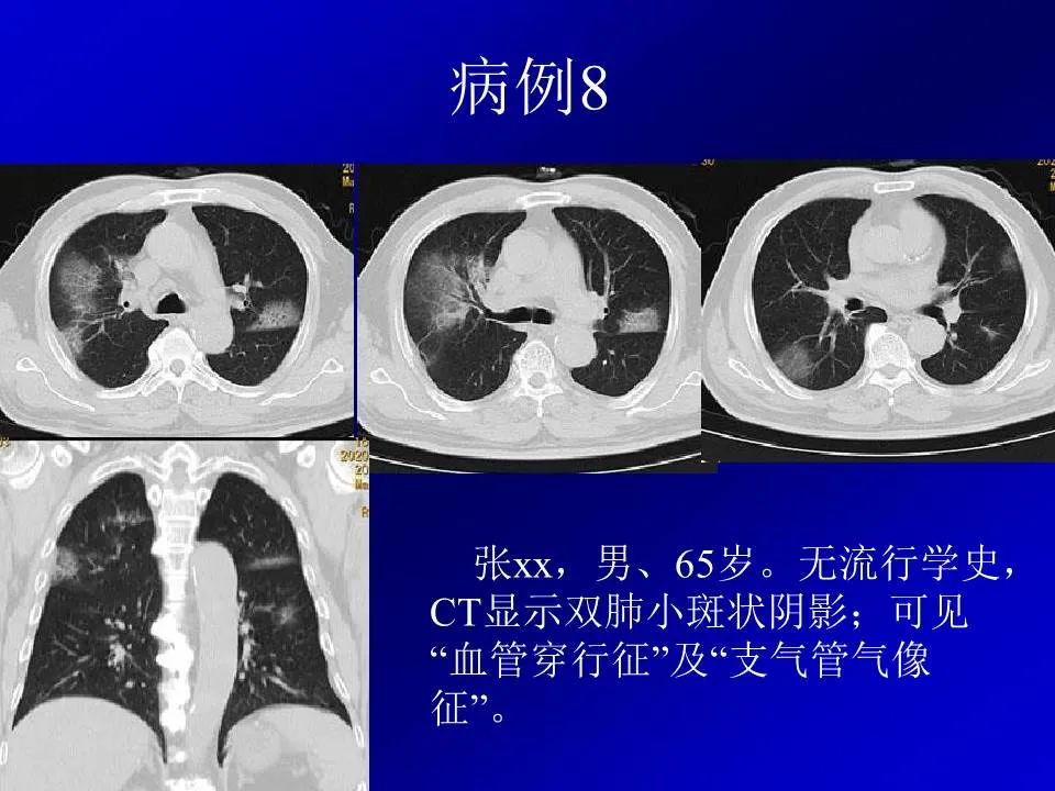 【PPT】新型冠状病毒肺炎影像学诊断及鉴别诊断