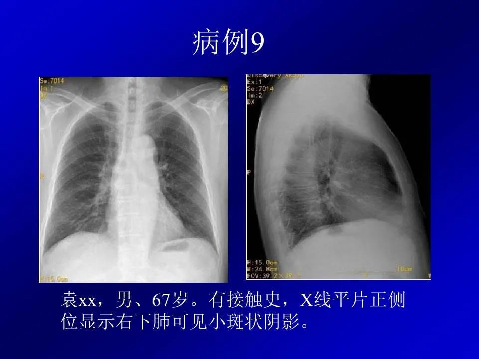 【PPT】新型冠状病毒肺炎影像学诊断及鉴别诊断