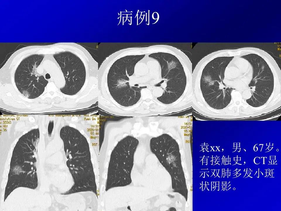 【PPT】新型冠状病毒肺炎影像学诊断及鉴别诊断
