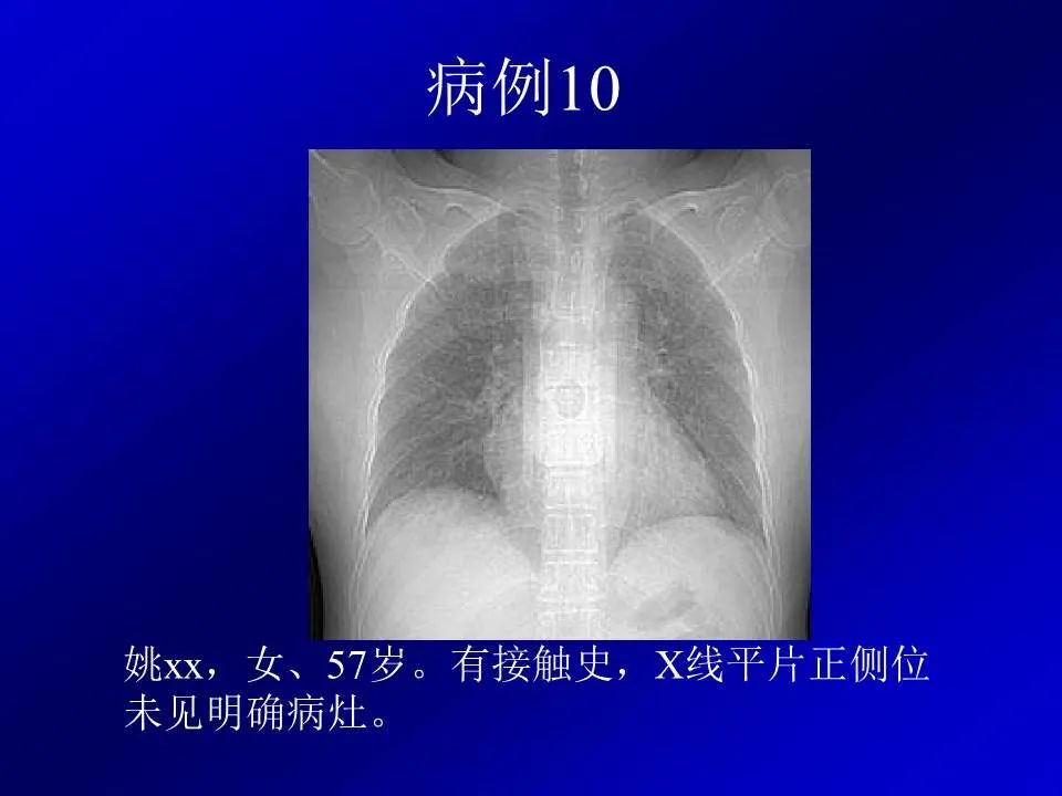 【PPT】新型冠状病毒肺炎影像学诊断及鉴别诊断
