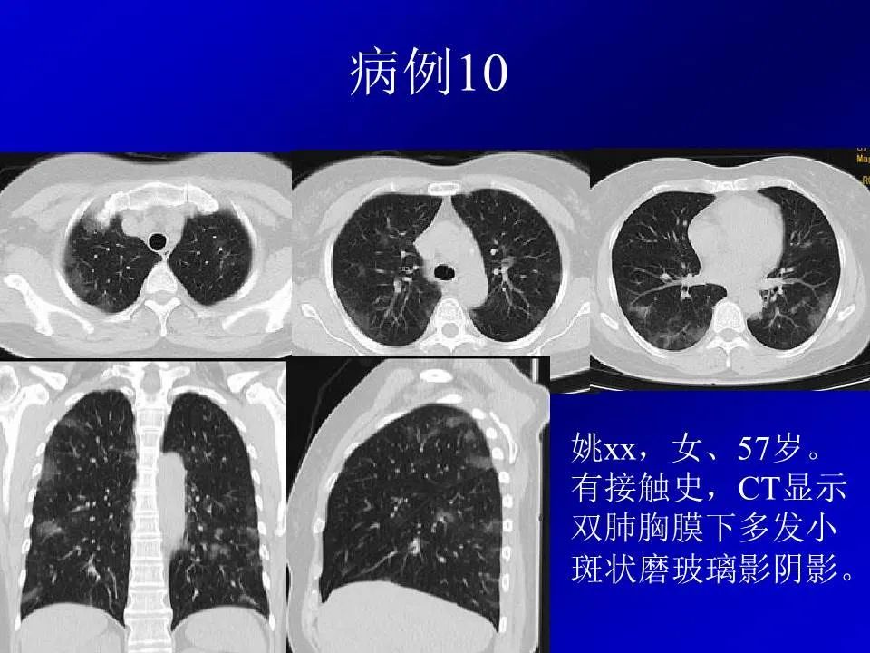 【PPT】新型冠状病毒肺炎影像学诊断及鉴别诊断