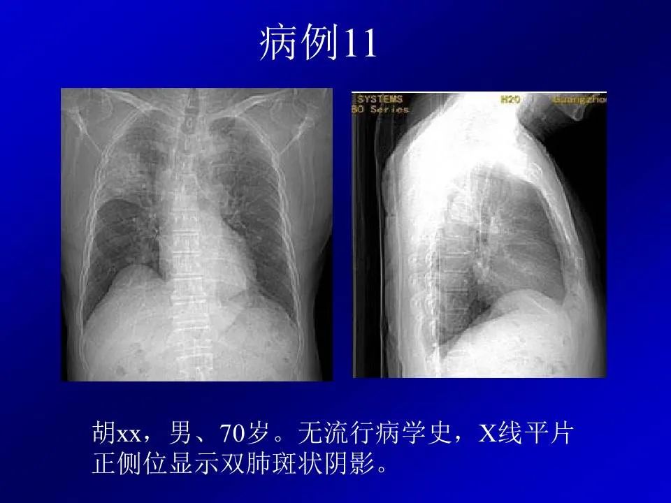 【PPT】新型冠状病毒肺炎影像学诊断及鉴别诊断