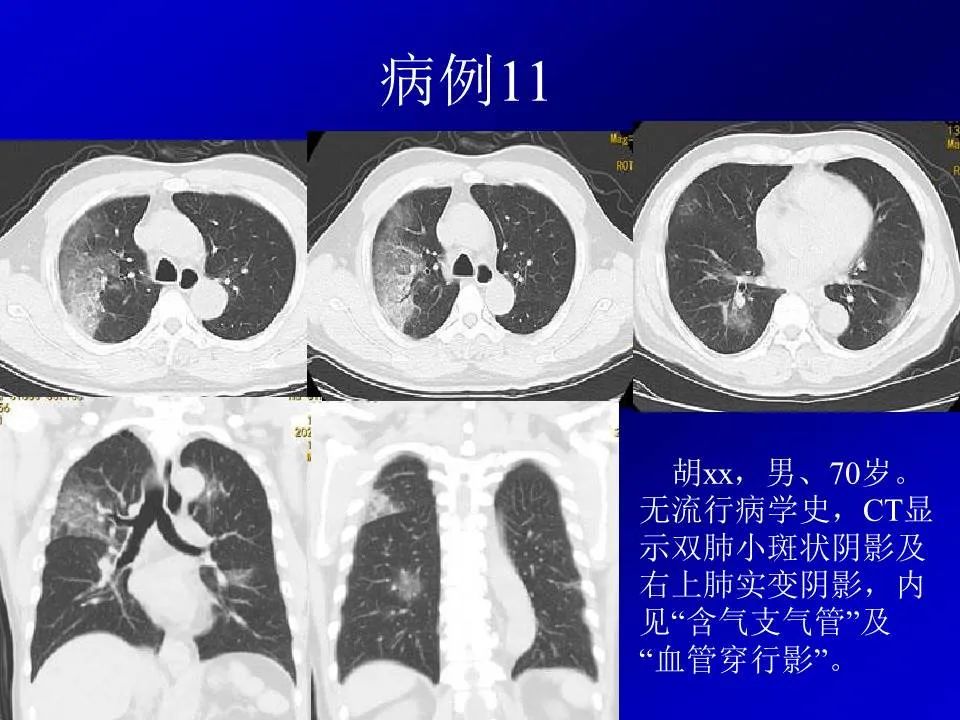 【PPT】新型冠状病毒肺炎影像学诊断及鉴别诊断