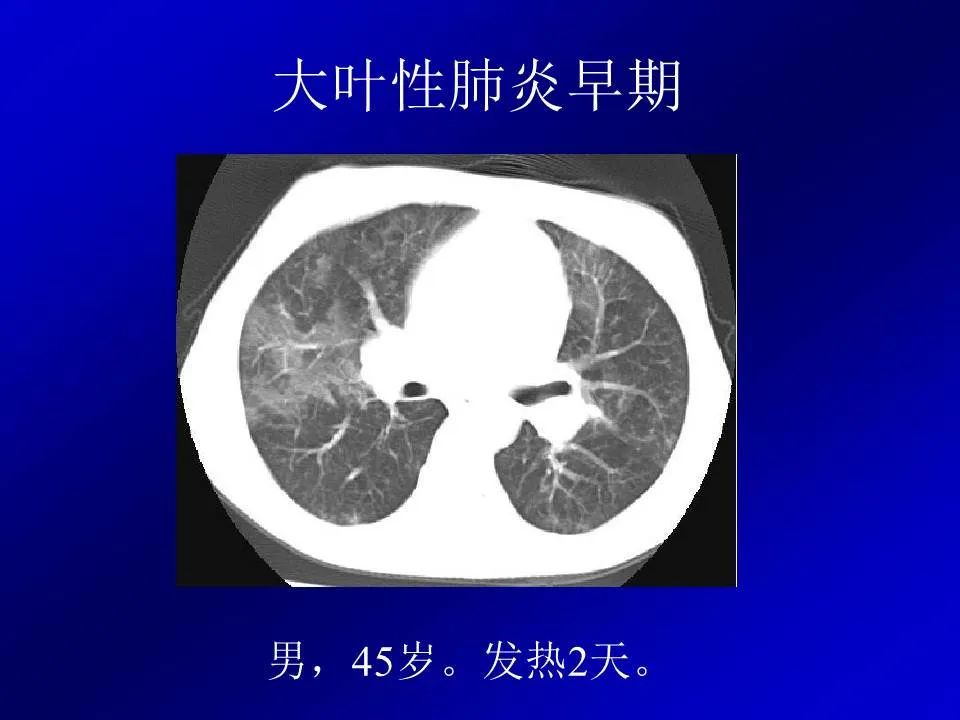 【PPT】新型冠状病毒肺炎影像学诊断及鉴别诊断
