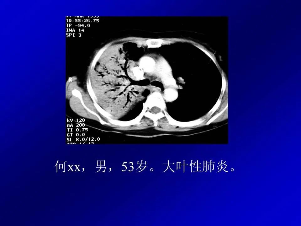 【PPT】新型冠状病毒肺炎影像学诊断及鉴别诊断