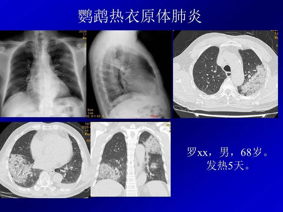 【PPT】新型冠状病毒肺炎影像学诊断及鉴别诊断