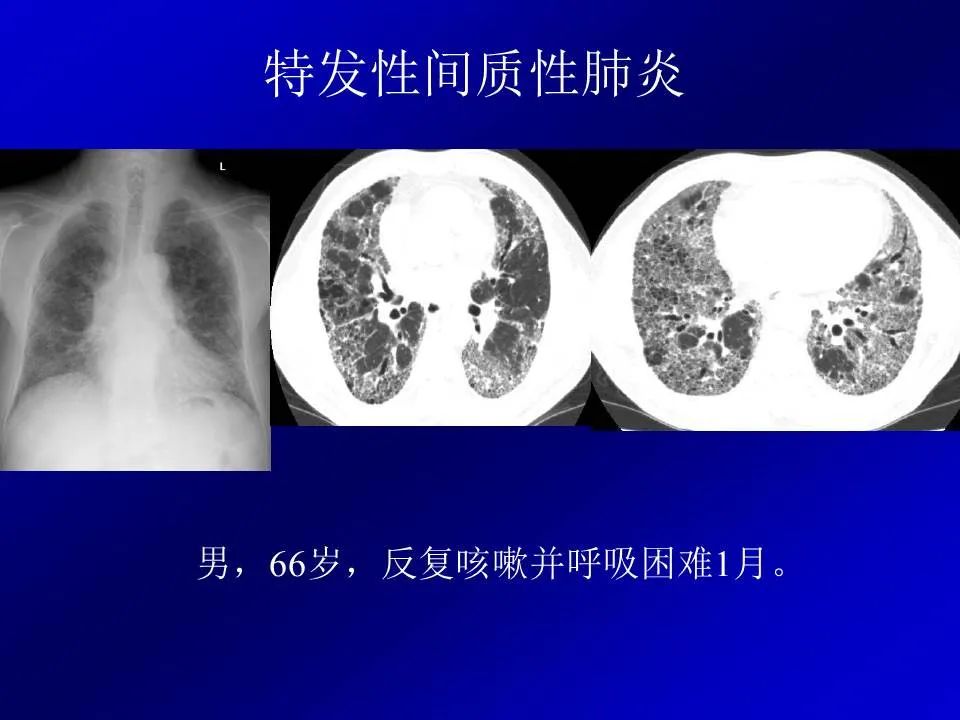 【PPT】新型冠状病毒肺炎影像学诊断及鉴别诊断