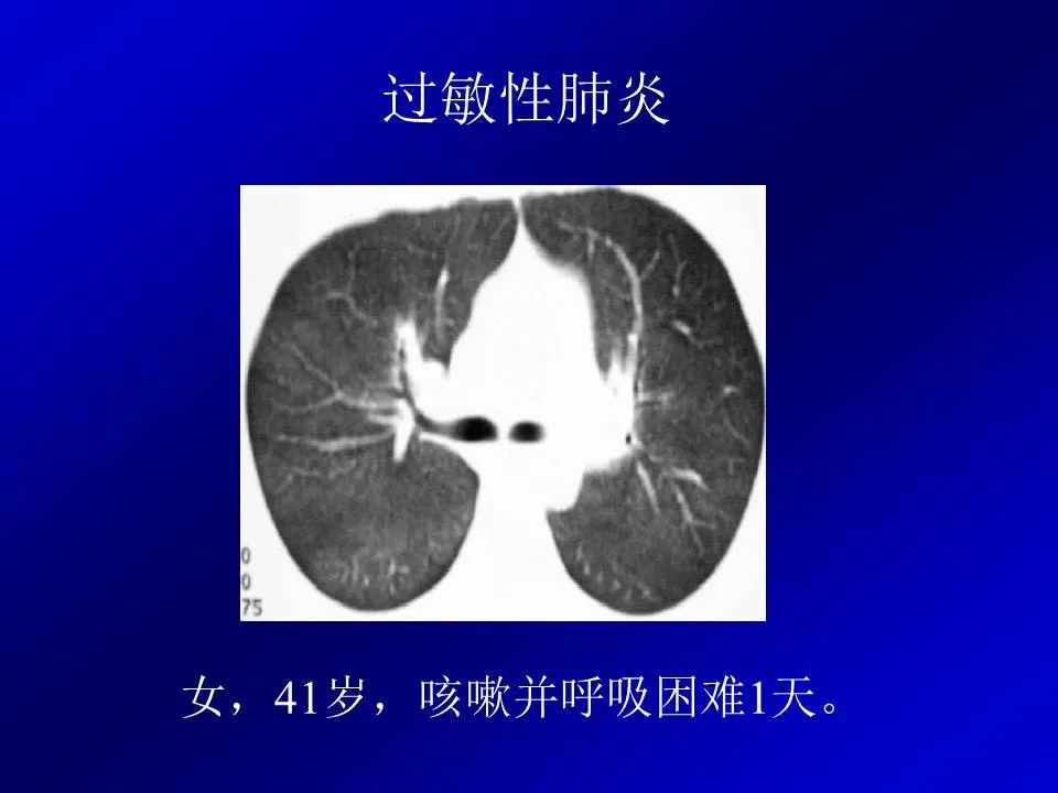 【PPT】新型冠状病毒肺炎影像学诊断及鉴别诊断
