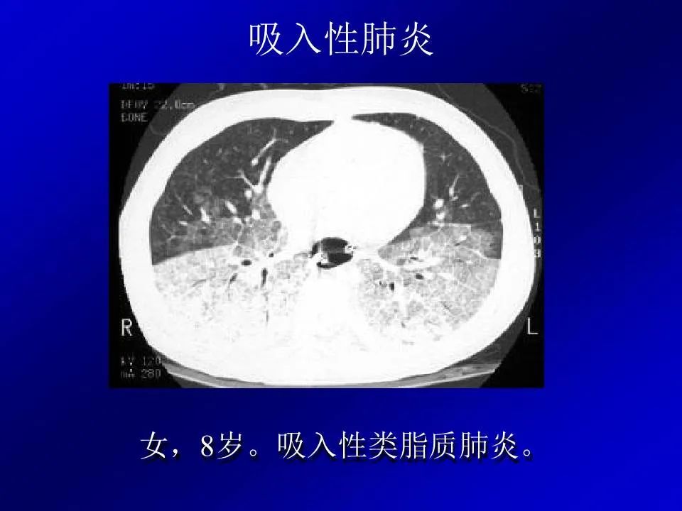 【PPT】新型冠状病毒肺炎影像学诊断及鉴别诊断