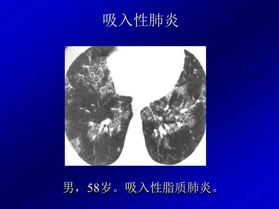 【PPT】新型冠状病毒肺炎影像学诊断及鉴别诊断