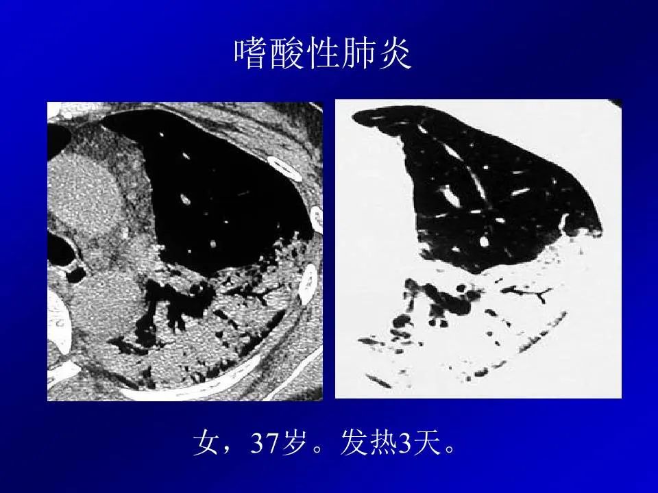 【PPT】新型冠状病毒肺炎影像学诊断及鉴别诊断
