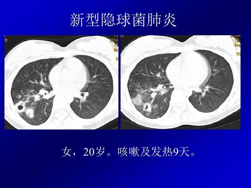【PPT】新型冠状病毒肺炎影像学诊断及鉴别诊断