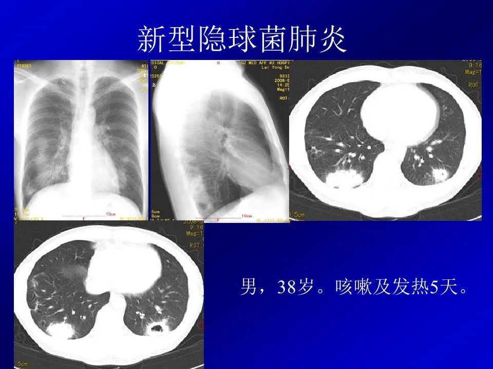 【PPT】新型冠状病毒肺炎影像学诊断及鉴别诊断