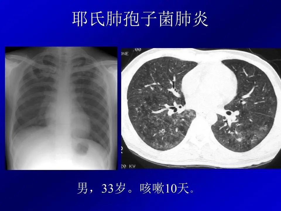 【PPT】新型冠状病毒肺炎影像学诊断及鉴别诊断