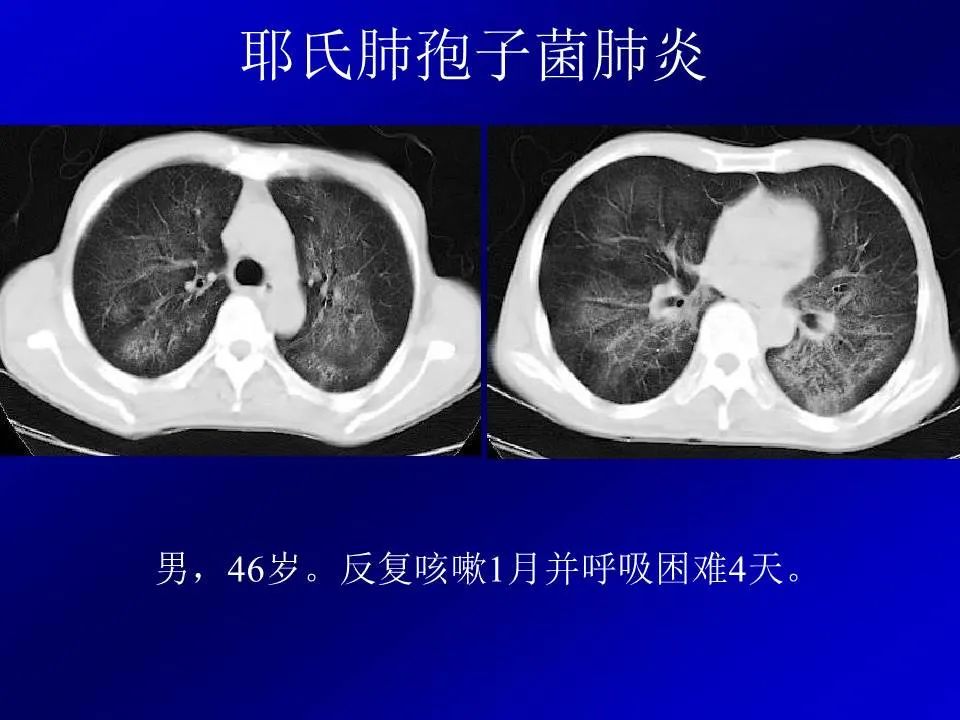 【PPT】新型冠状病毒肺炎影像学诊断及鉴别诊断