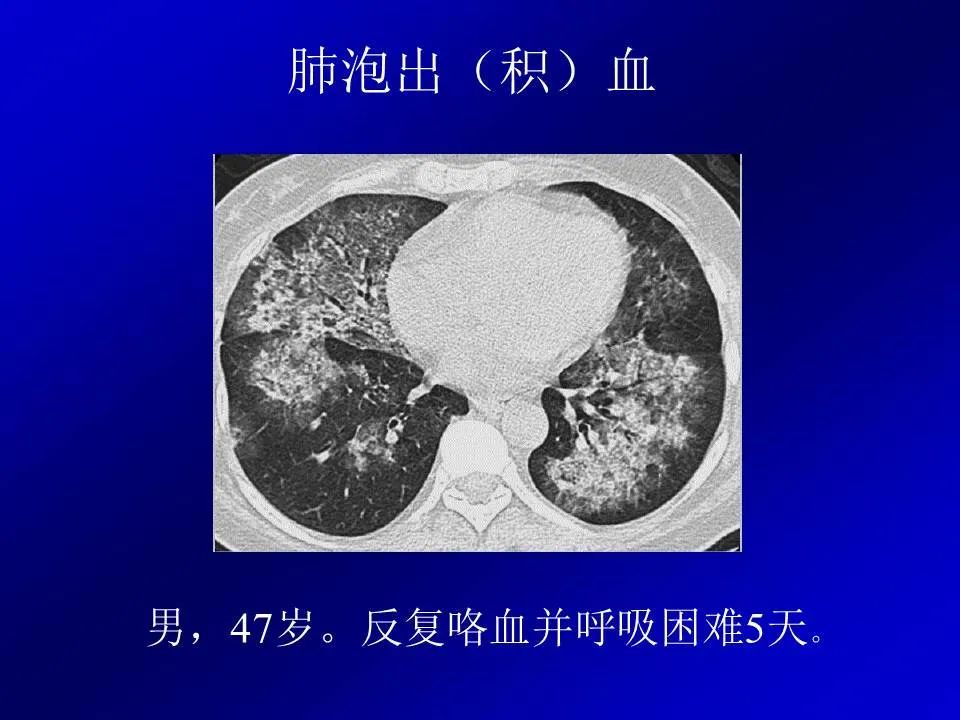 【PPT】新型冠状病毒肺炎影像学诊断及鉴别诊断