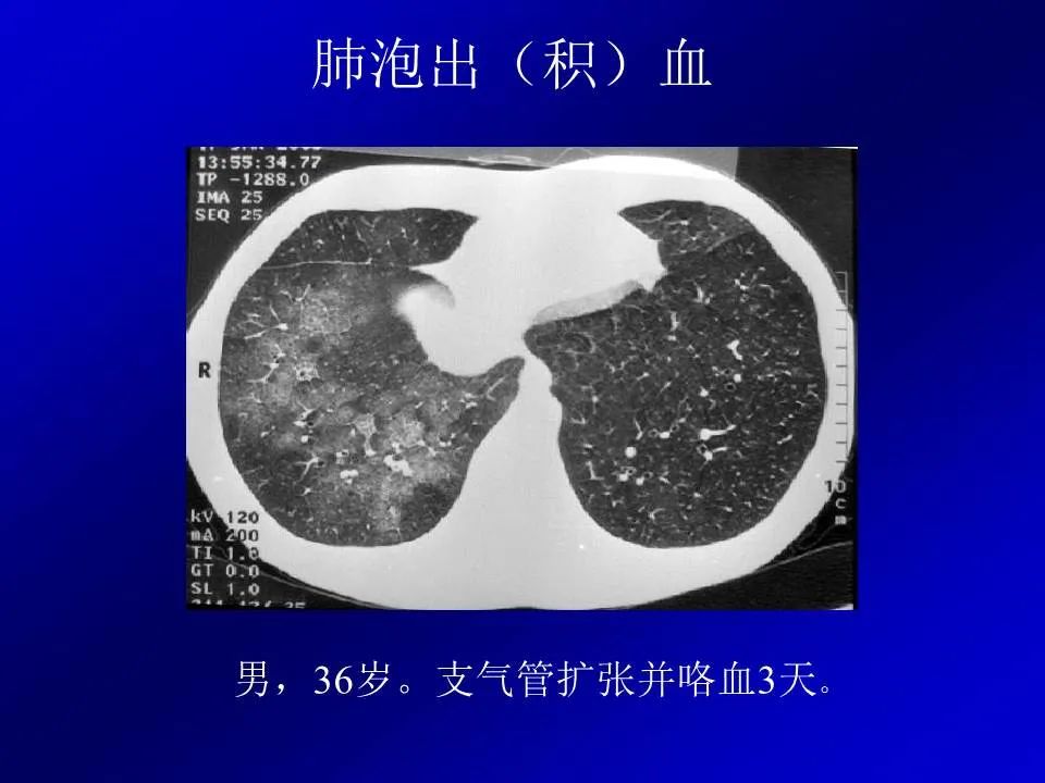 【PPT】新型冠状病毒肺炎影像学诊断及鉴别诊断