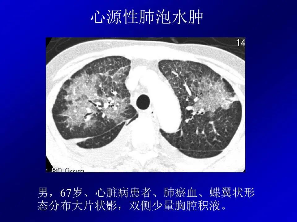 【PPT】新型冠状病毒肺炎影像学诊断及鉴别诊断