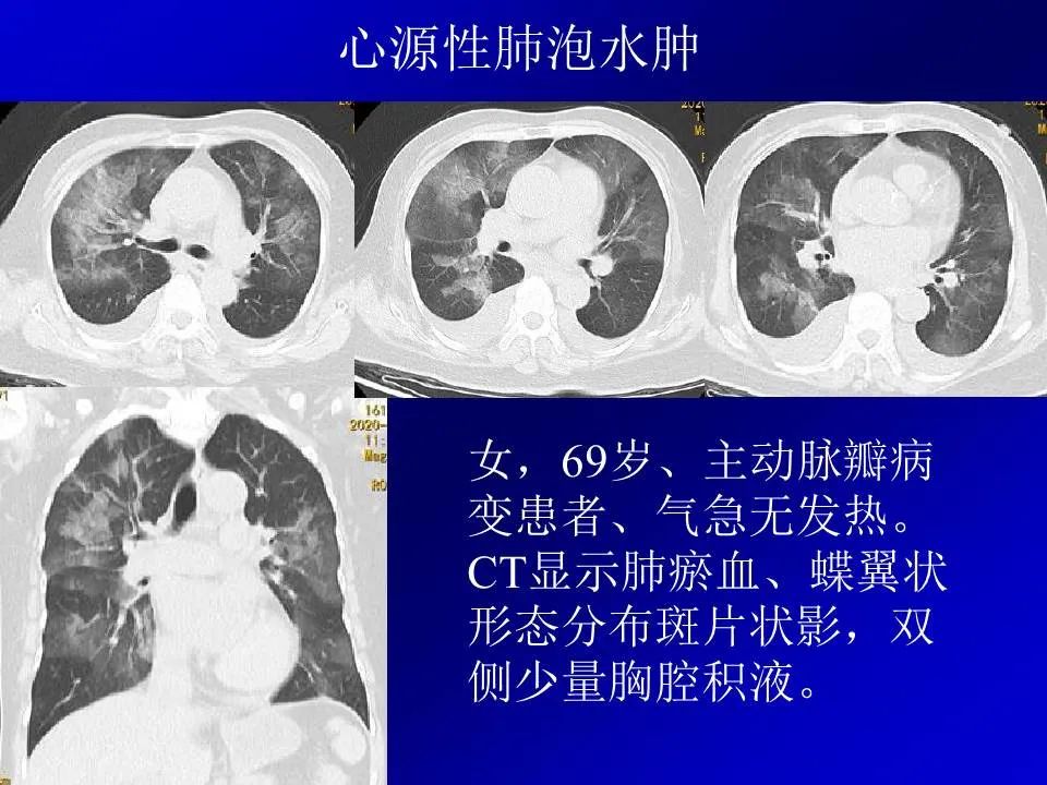 【PPT】新型冠状病毒肺炎影像学诊断及鉴别诊断