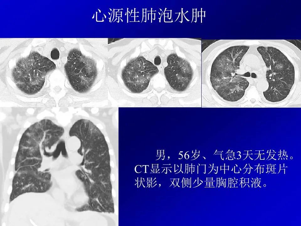 【PPT】新型冠状病毒肺炎影像学诊断及鉴别诊断
