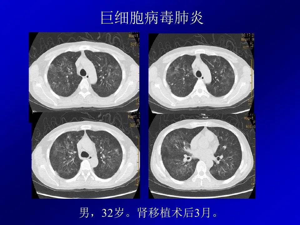 【PPT】新型冠状病毒肺炎影像学诊断及鉴别诊断