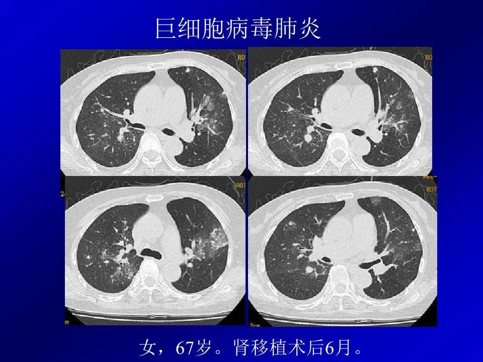 【PPT】新型冠状病毒肺炎影像学诊断及鉴别诊断