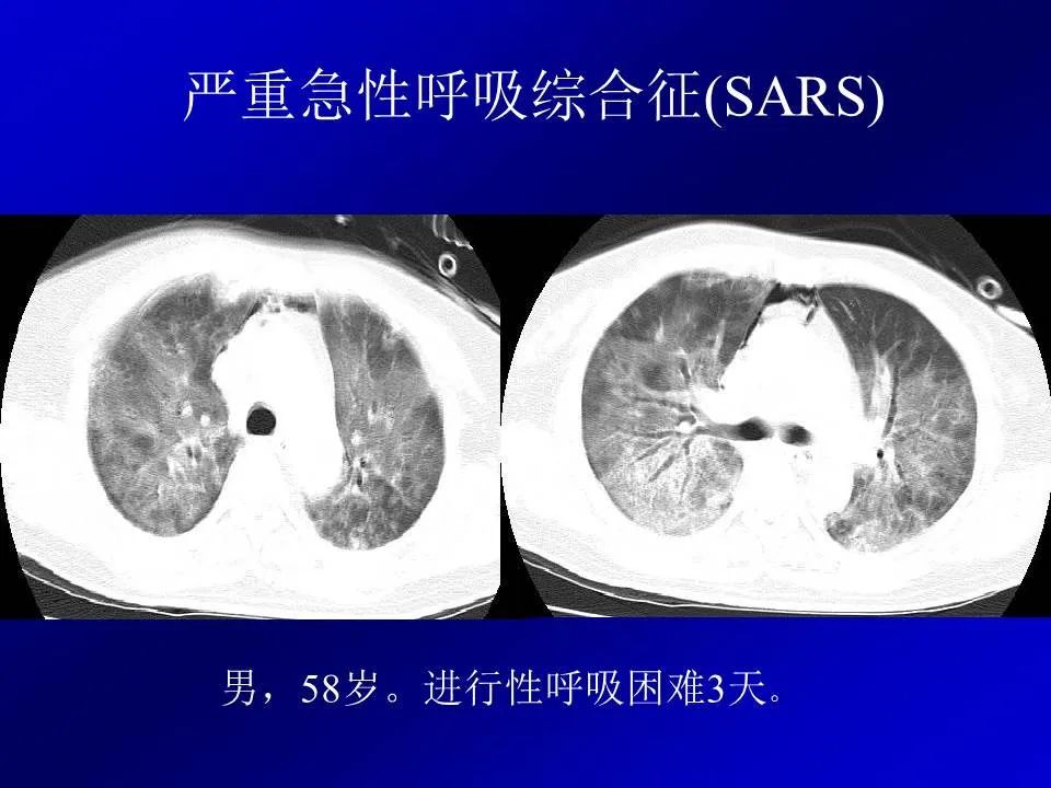 【PPT】新型冠状病毒肺炎影像学诊断及鉴别诊断