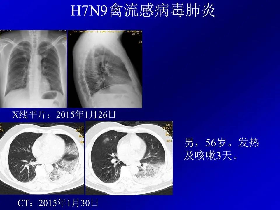 【PPT】新型冠状病毒肺炎影像学诊断及鉴别诊断