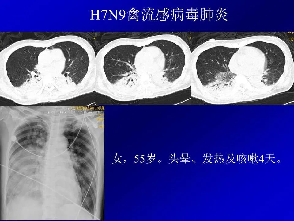 【PPT】新型冠状病毒肺炎影像学诊断及鉴别诊断