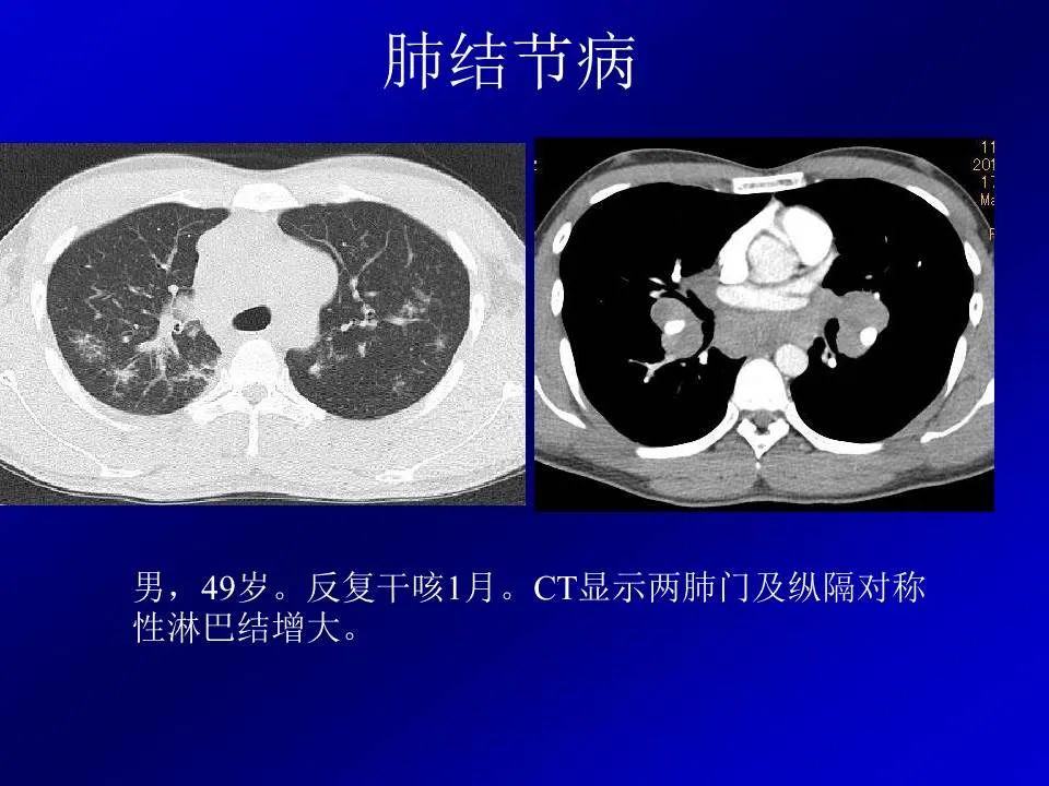 【PPT】新型冠状病毒肺炎影像学诊断及鉴别诊断