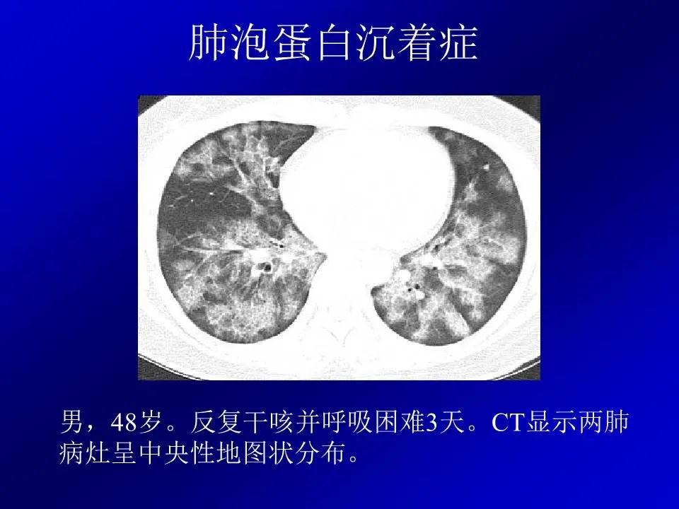 【PPT】新型冠状病毒肺炎影像学诊断及鉴别诊断