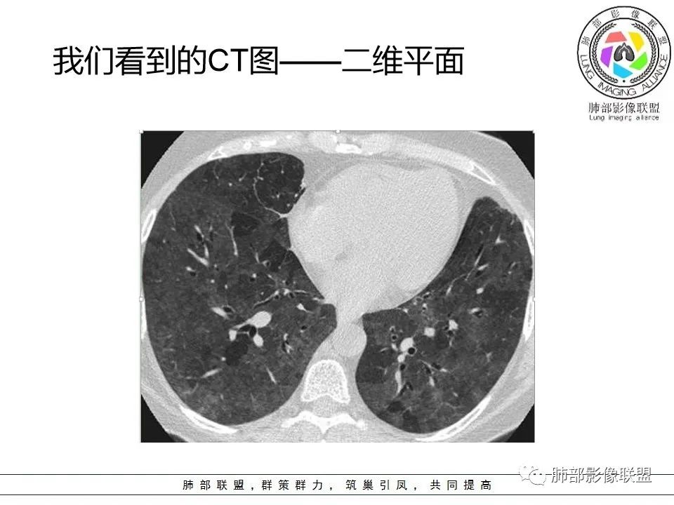 【PPT】如何快速掌握新冠肺炎(NCP)的影像识别? 【PPT】如何快速掌握新冠肺炎(NCP)的影像识别?