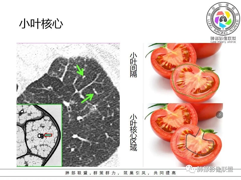 【PPT】如何快速掌握新冠肺炎(NCP)的影像识别? 【PPT】如何快速掌握新冠肺炎(NCP)的影像识别?