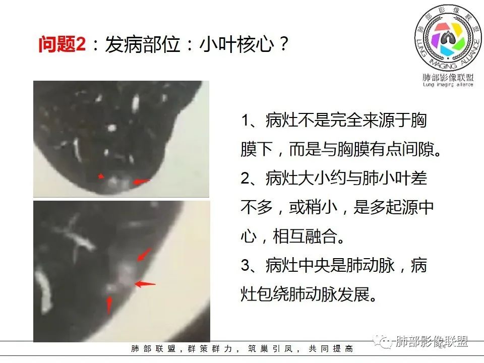 【PPT】如何快速掌握新冠肺炎(NCP)的影像识别? 【PPT】如何快速掌握新冠肺炎(NCP)的影像识别?