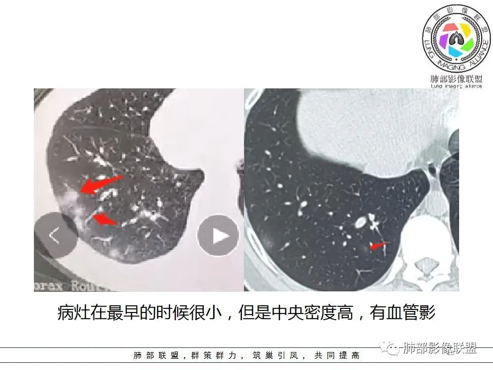 【PPT】如何快速掌握新冠肺炎(NCP)的影像识别? 【PPT】如何快速掌握新冠肺炎(NCP)的影像识别?