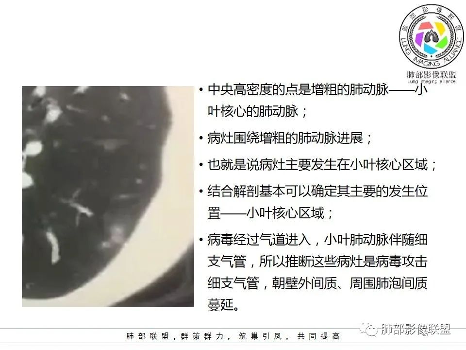 【PPT】如何快速掌握新冠肺炎(NCP)的影像识别? 【PPT】如何快速掌握新冠肺炎(NCP)的影像识别?